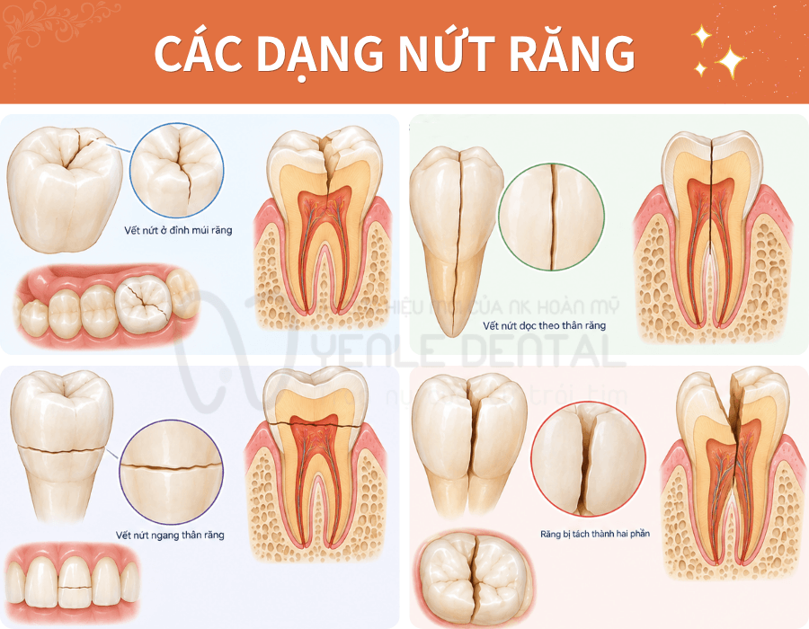 các dạng nứt răng